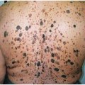 Seborrheic Kertosis