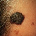 Seborrheic Kertosis
