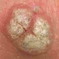 Warts