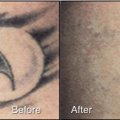 Tattoo Removal