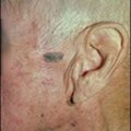 Seborrheic Kertosis