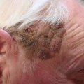 Seborrheic Kertosis
