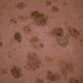 Seborrheic Kertosis