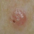 Skin Cancer