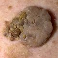 Seborrheic Kertosis