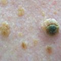 Seborrheic Kertosis
