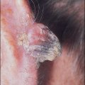 Skin Cancer