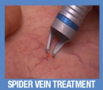 4rejuvadoc-SpiderVein2-58280b5882.jpg